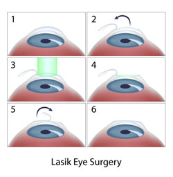 chirurgie réfractive par laser